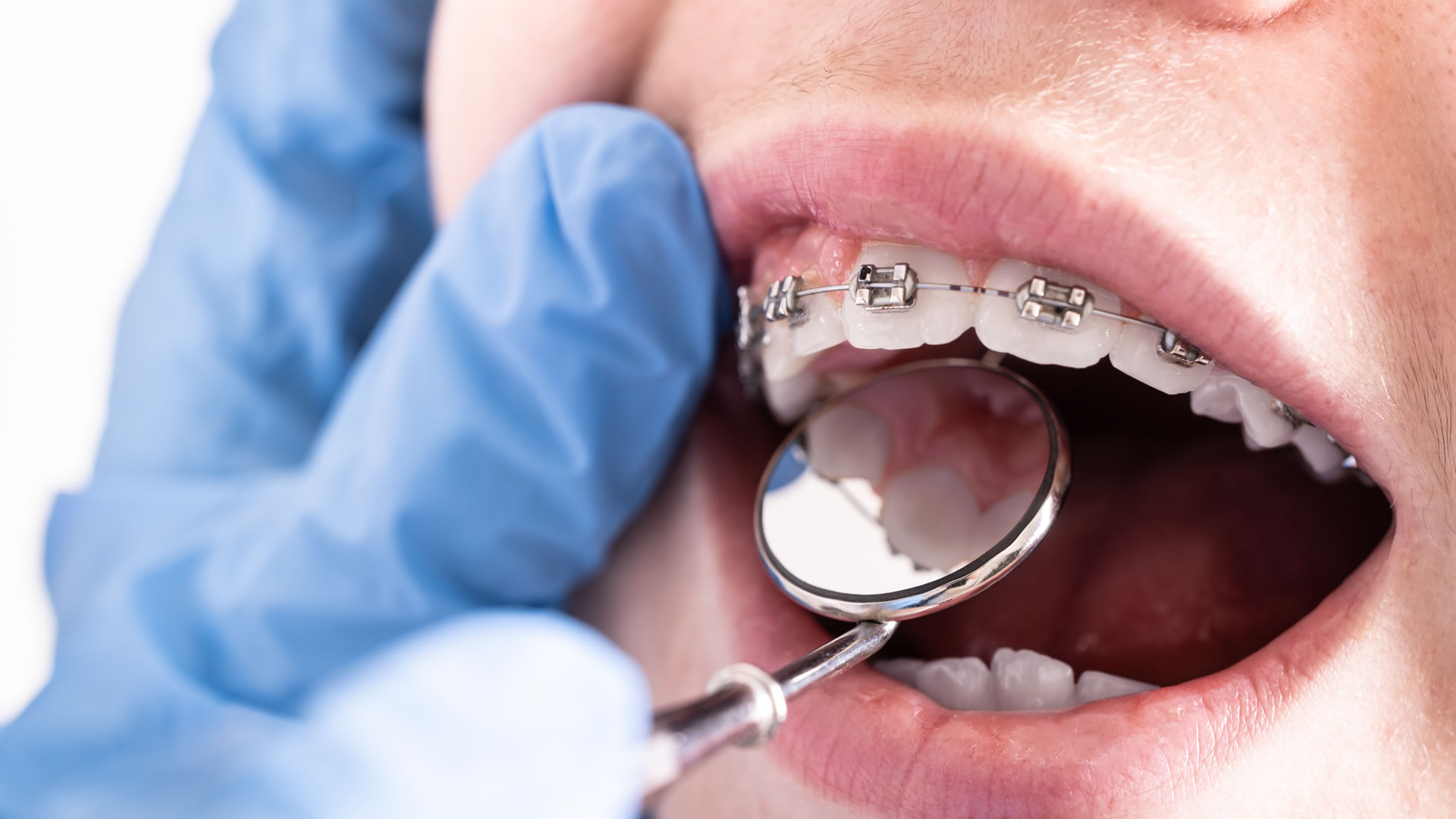 Zahnpflege bei festsitzender Zahnspange: So bleiben Zähne gesund